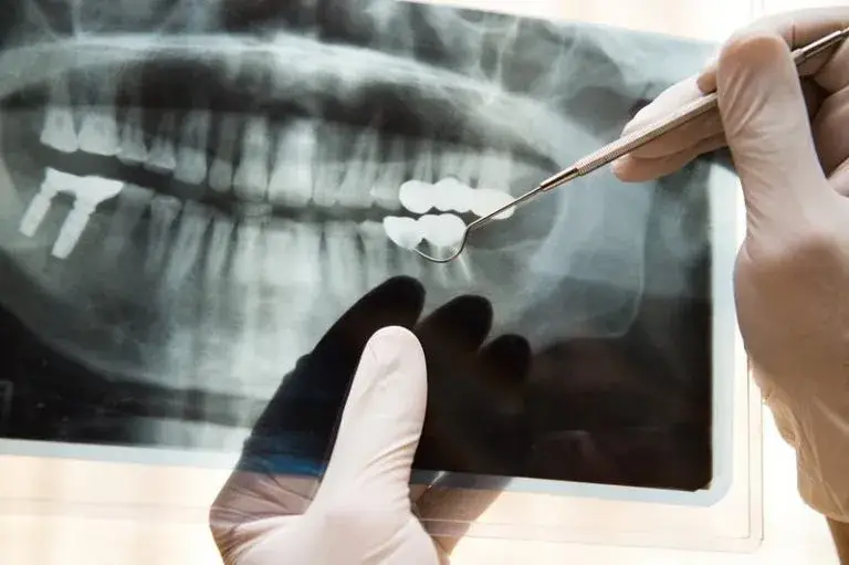 Oral Cancer Xray