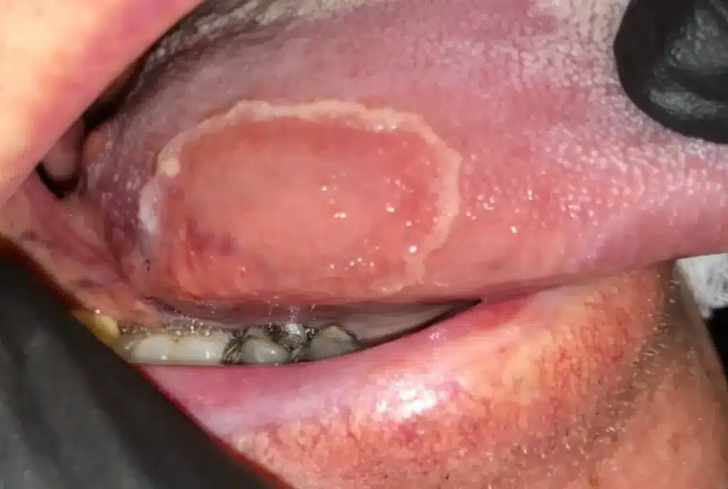 Oral Pathology