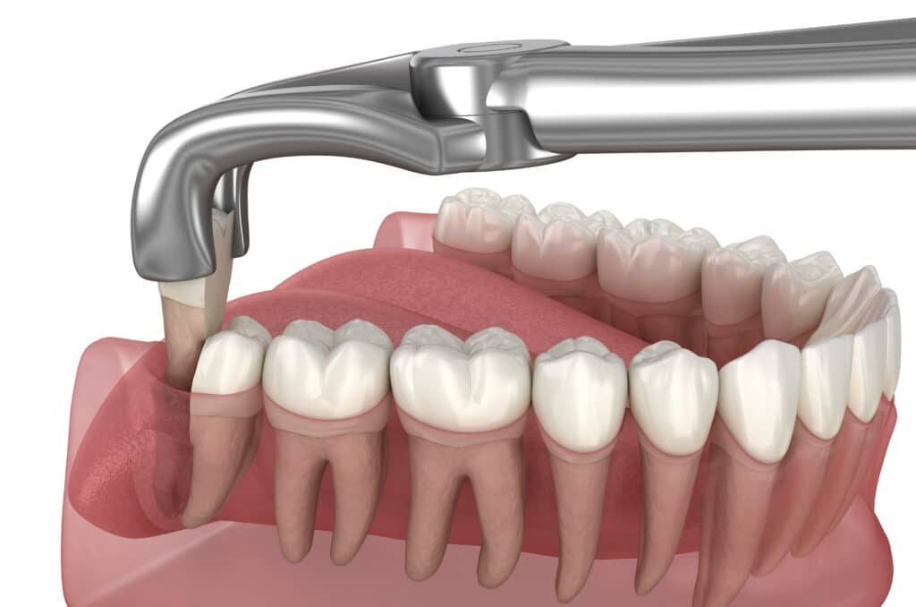 wisdom teeth extraction